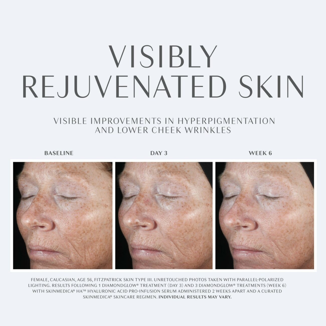 Discover Your Radiant Glow: Diamond Glow Facial Near Me