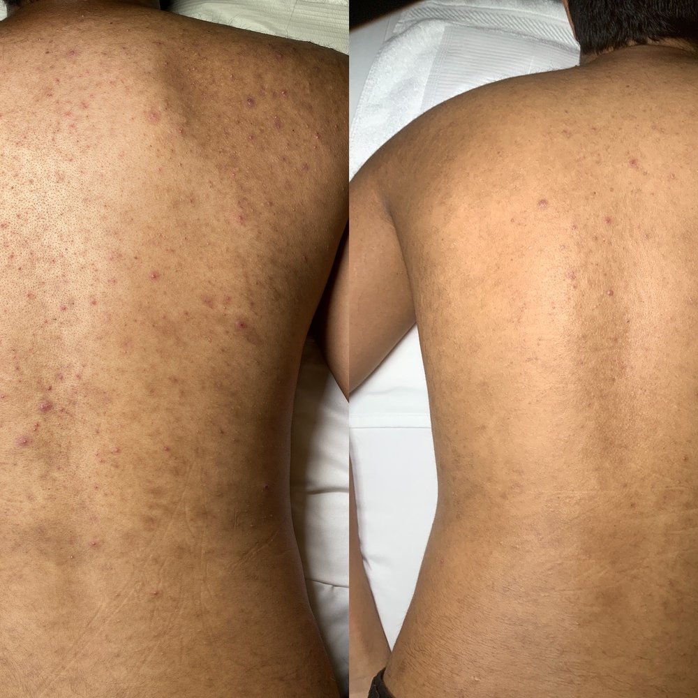 Discover the Ultimate Back Facial Experience Near Me